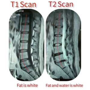 curves of spine 1 2