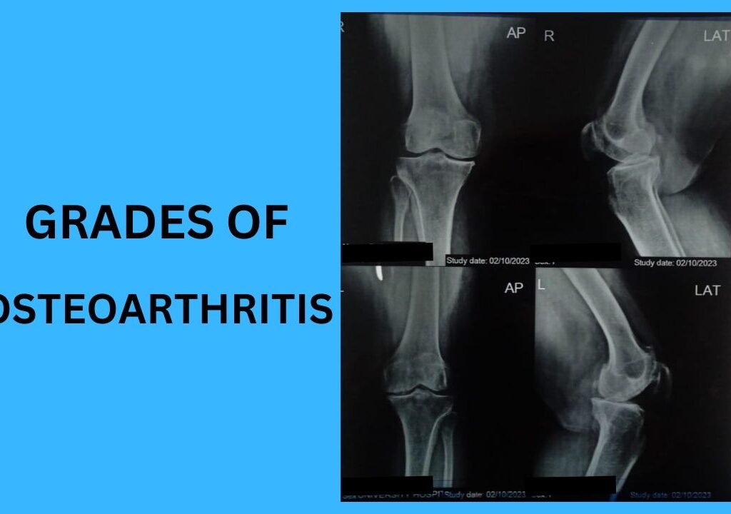 Grades of Osteoarthritis