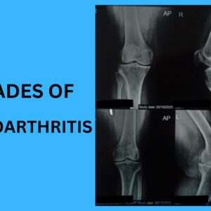 Read more about the article Grades of Osteoarthritis[The Best Concept 2023]